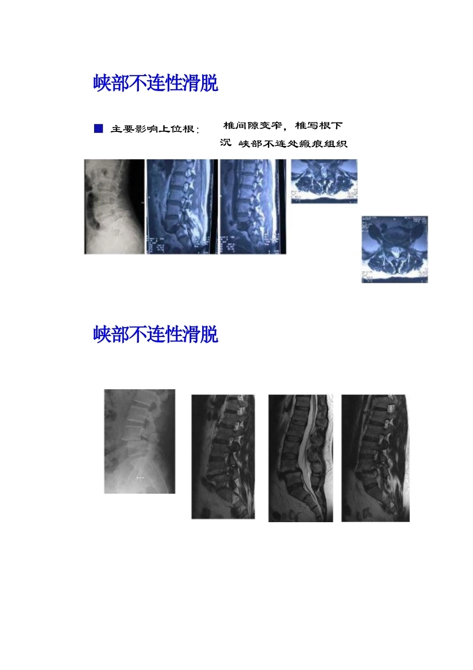 腰椎滑脱的临床分型_第15页