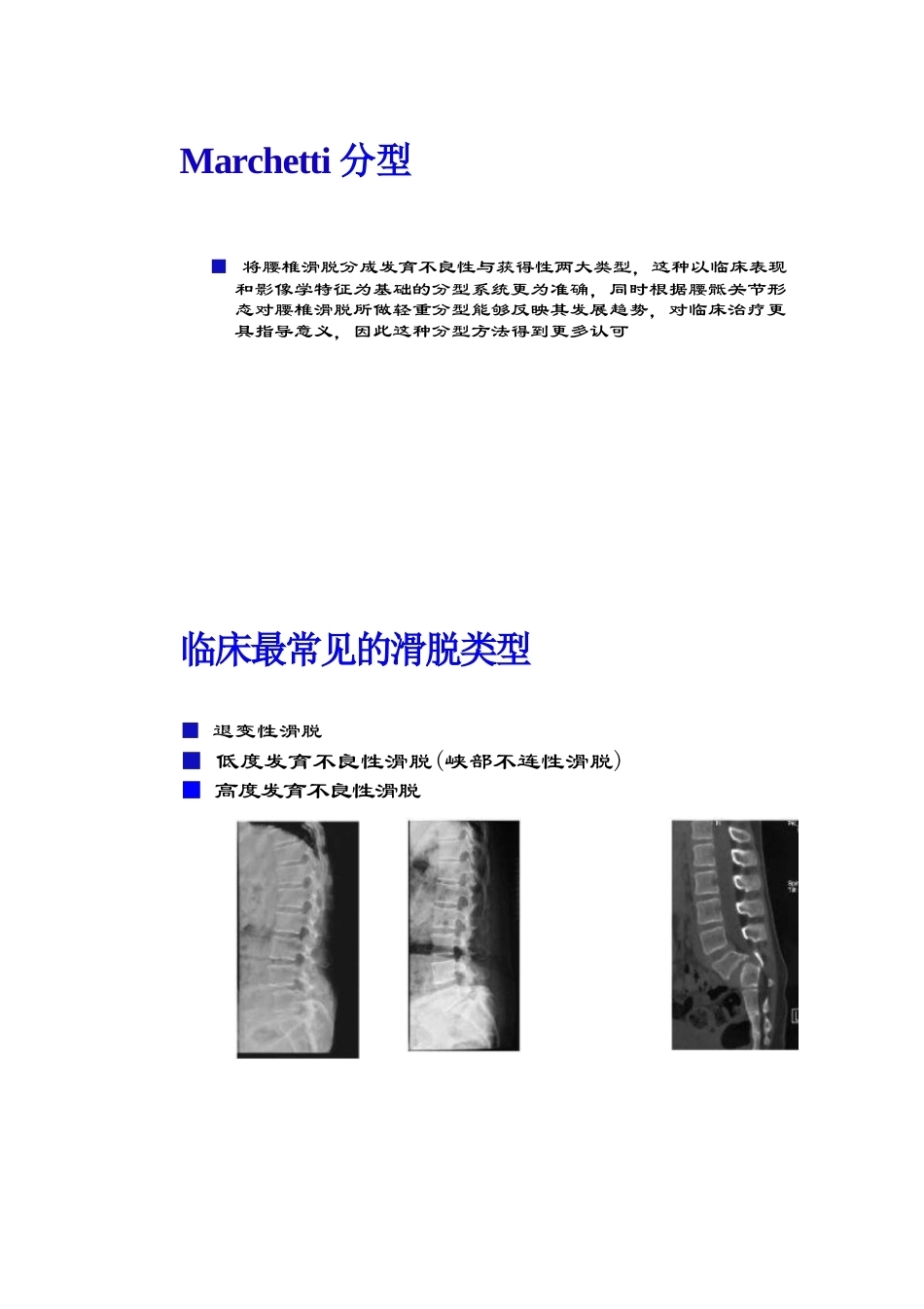腰椎滑脱的临床分型_第3页
