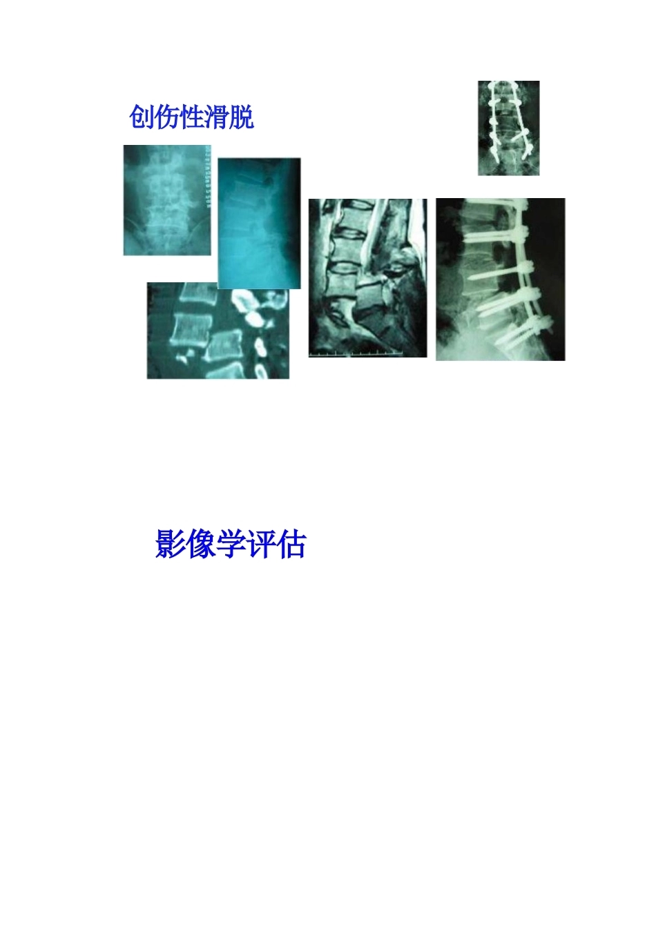 腰椎滑脱的临床分型_第4页