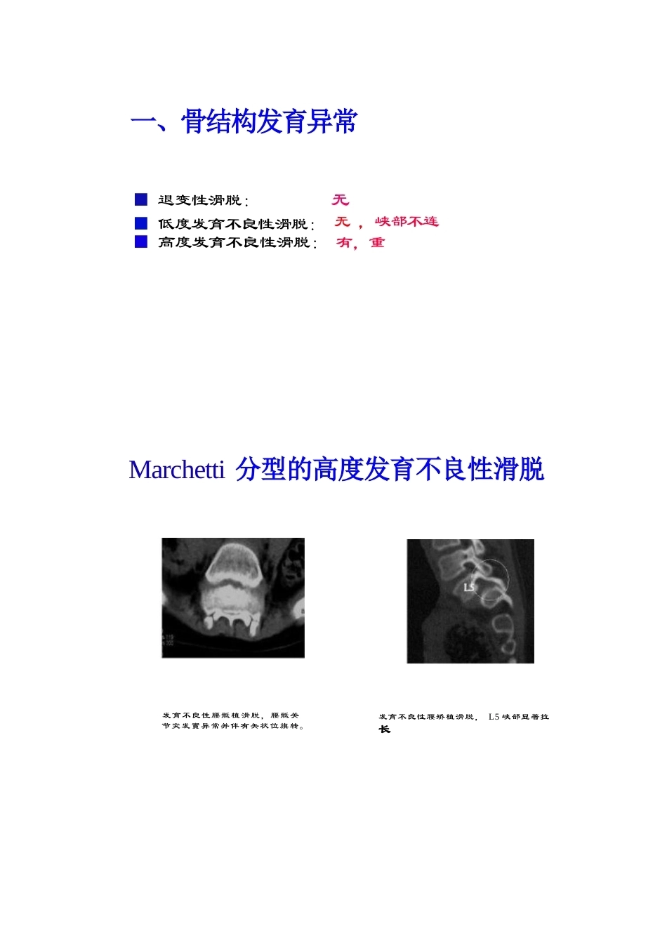 腰椎滑脱的临床分型_第5页