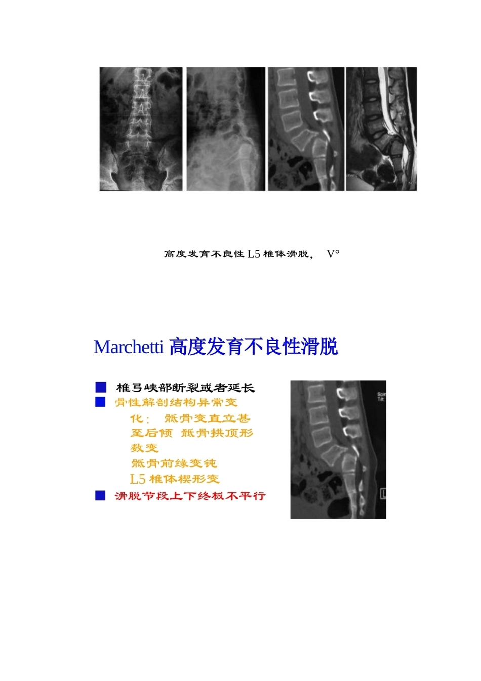 腰椎滑脱的临床分型_第6页