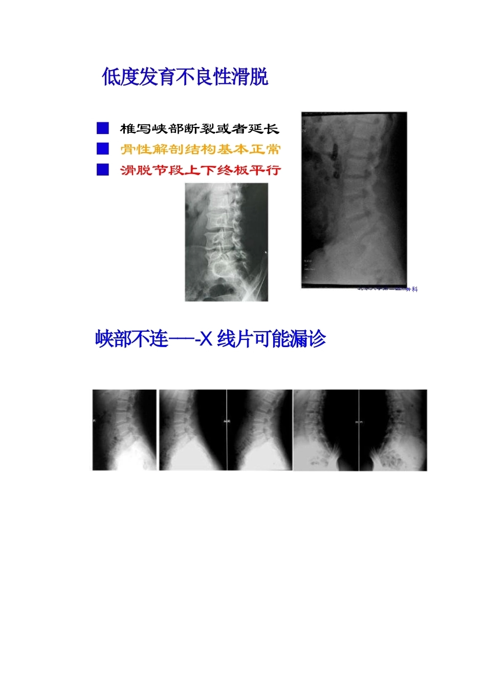 腰椎滑脱的临床分型_第8页