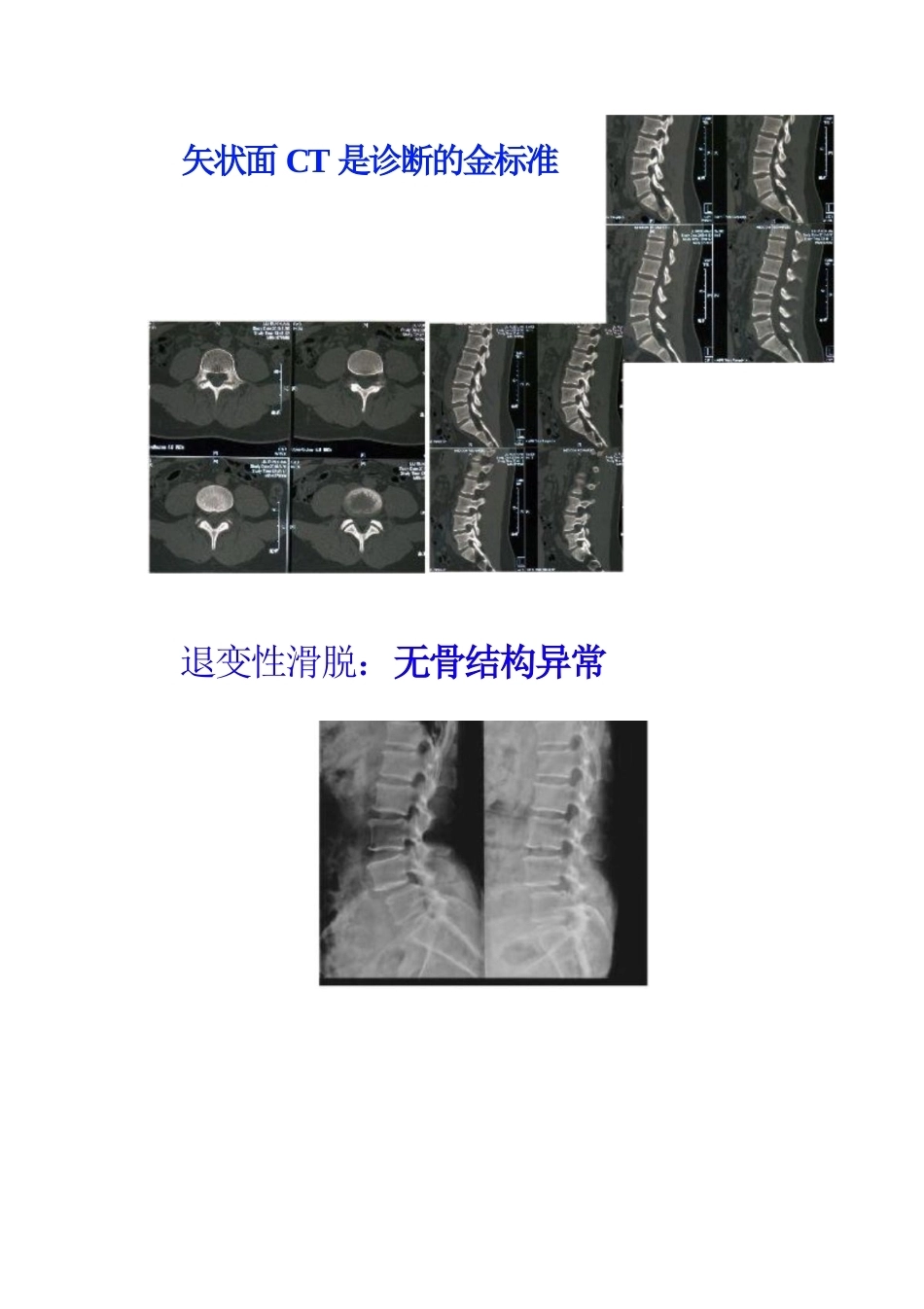 腰椎滑脱的临床分型_第9页