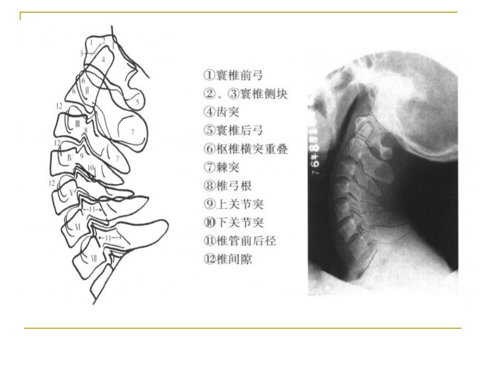 脊柱x片 诊断_第7页