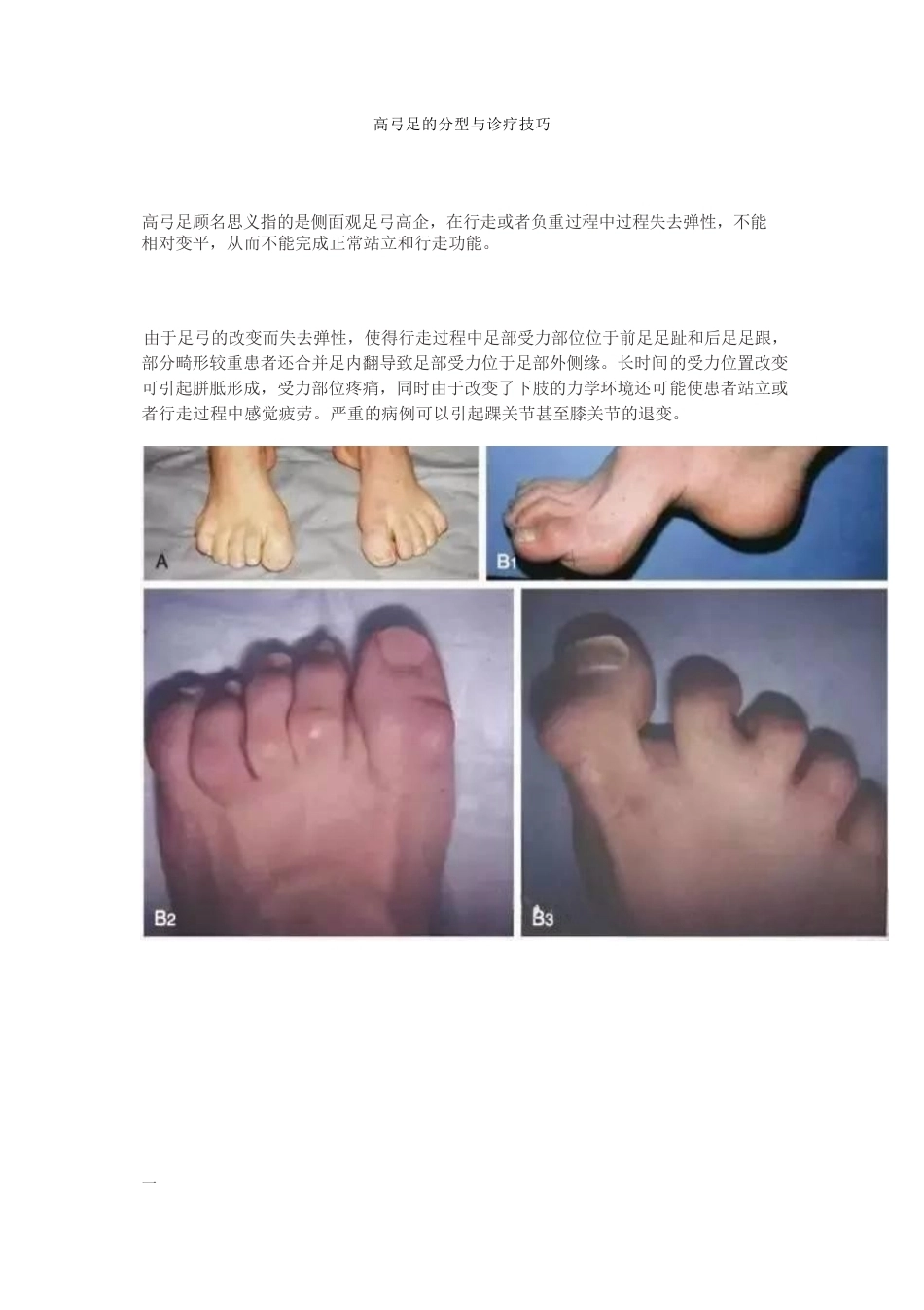 高弓足的分型_第1页