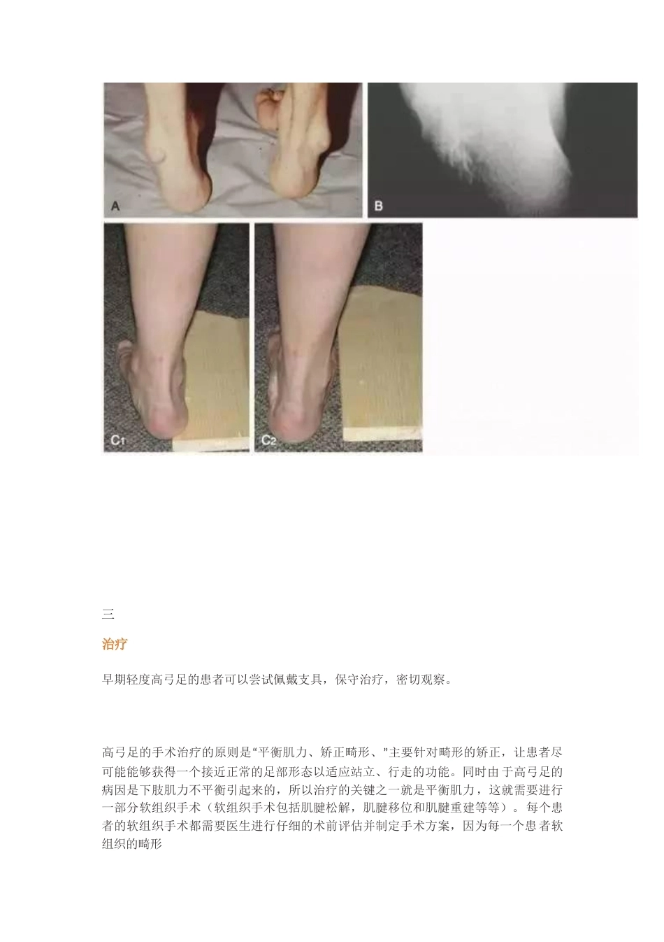 高弓足的分型_第4页