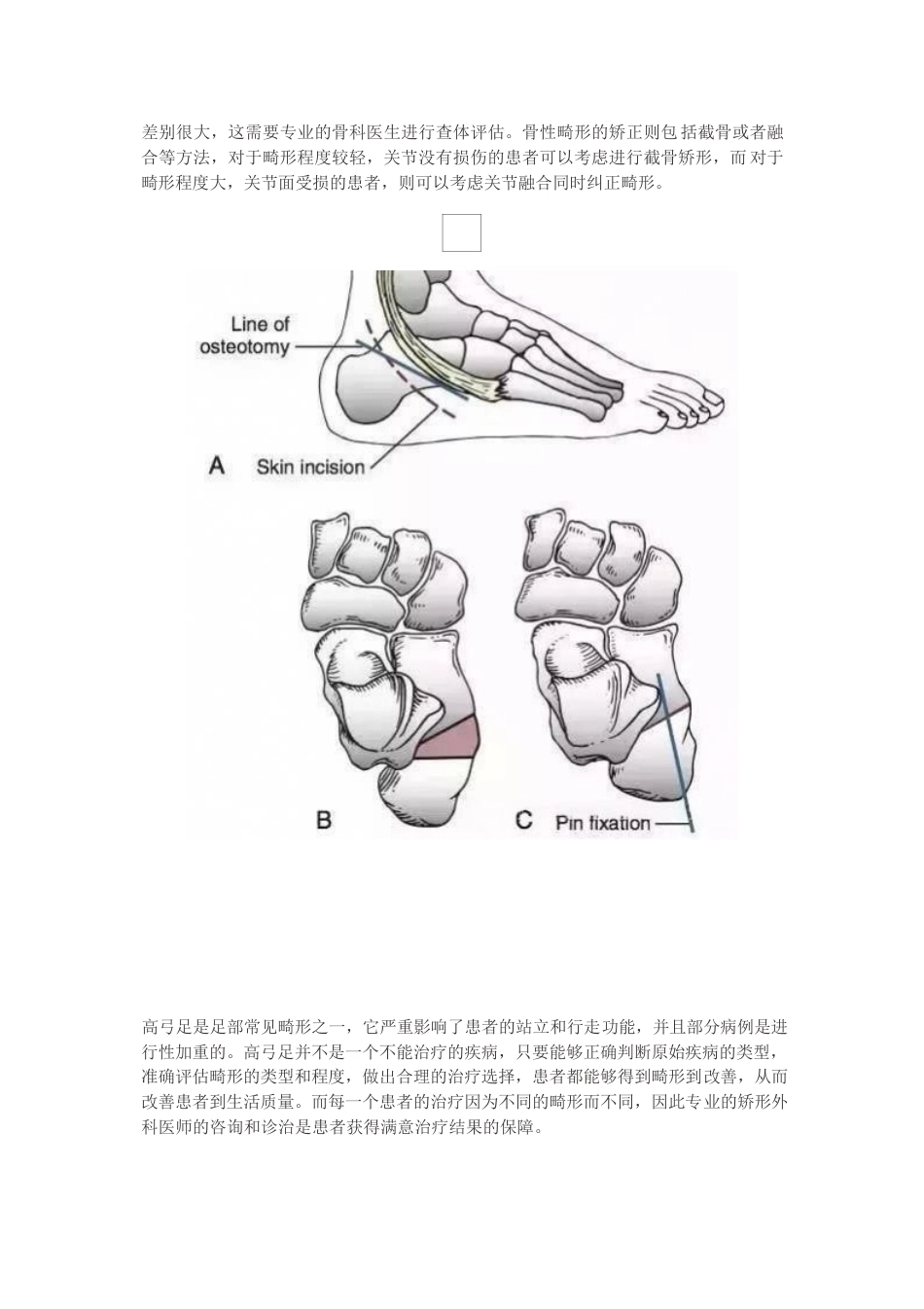 高弓足的分型_第5页