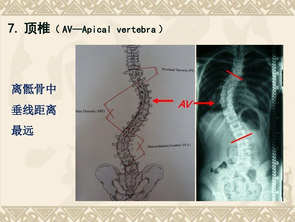 脊柱侧弯的治疗与 对策_第10页