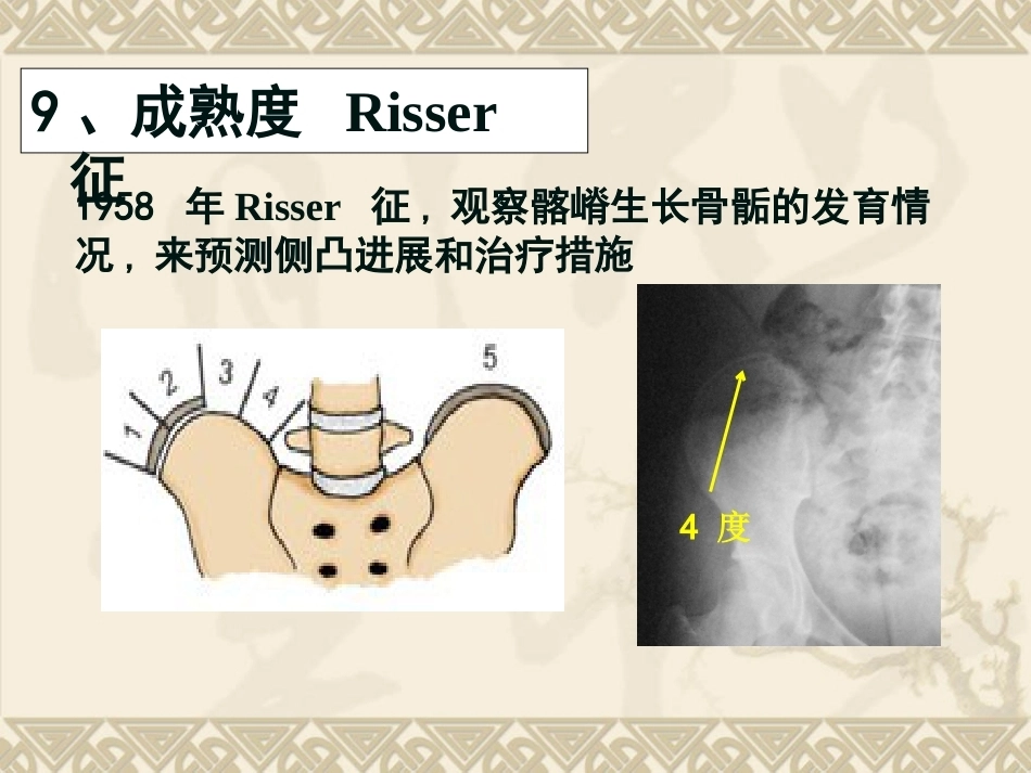 脊柱侧弯的治疗与 对策_第13页