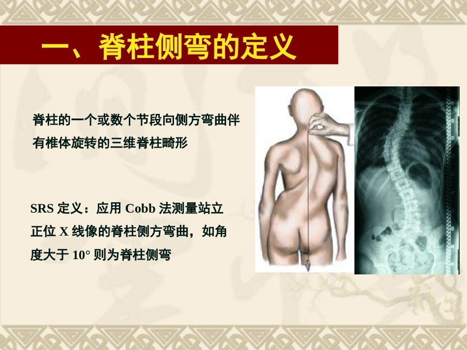 脊柱侧弯的治疗与 对策_第2页