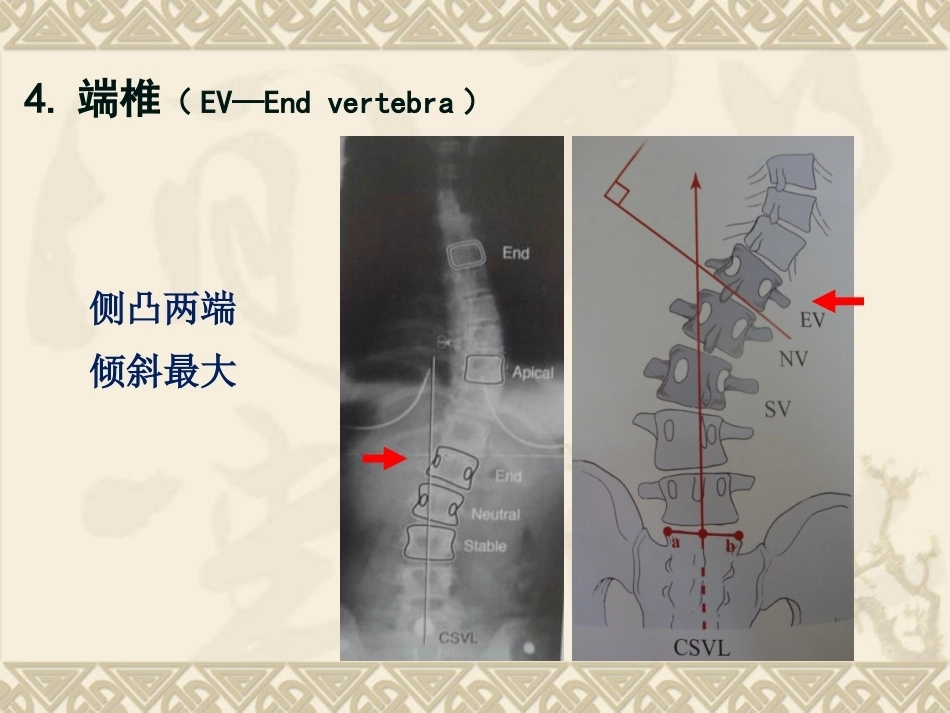 脊柱侧弯的治疗与 对策_第7页