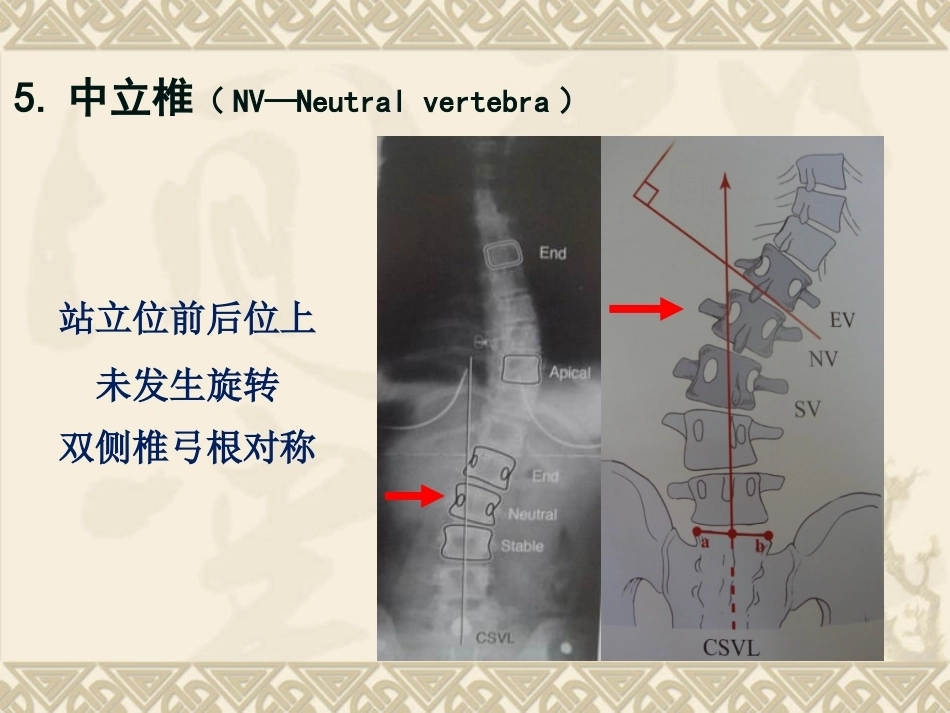 脊柱侧弯的治疗与 对策_第8页