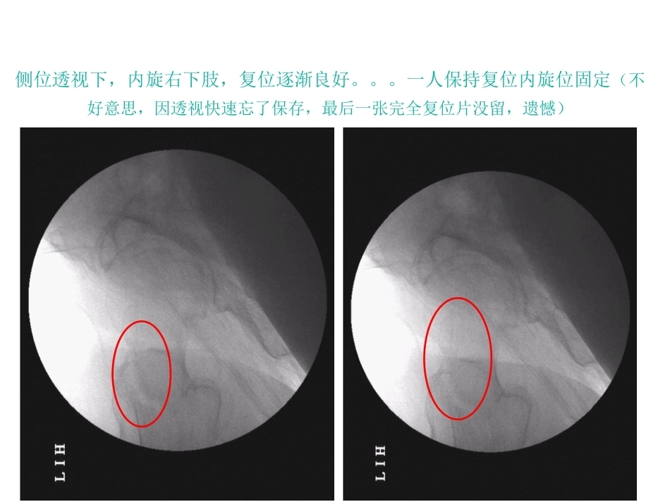股骨近端骨折的几个感悟_第10页