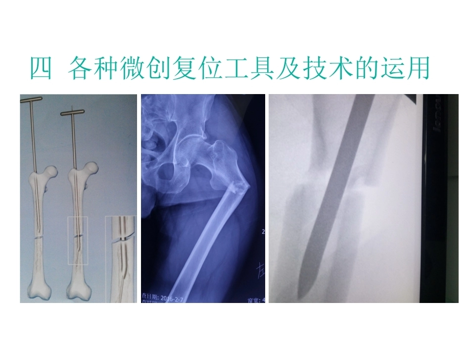 股骨近端骨折的几个感悟_第11页