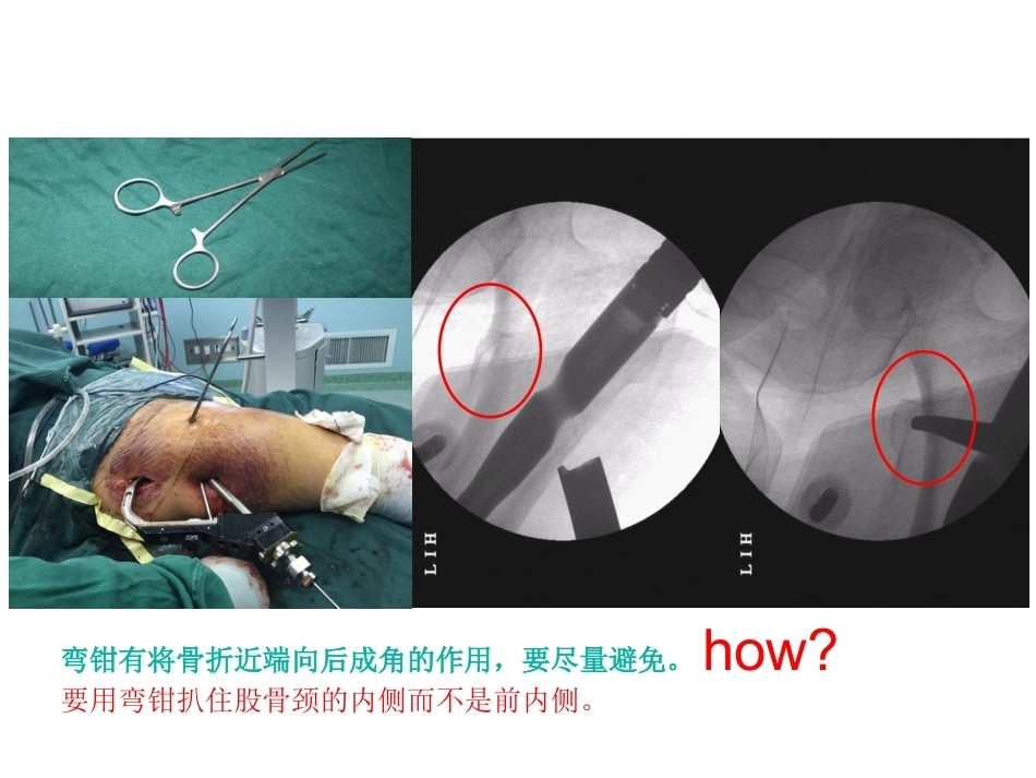 股骨近端骨折的几个感悟_第12页