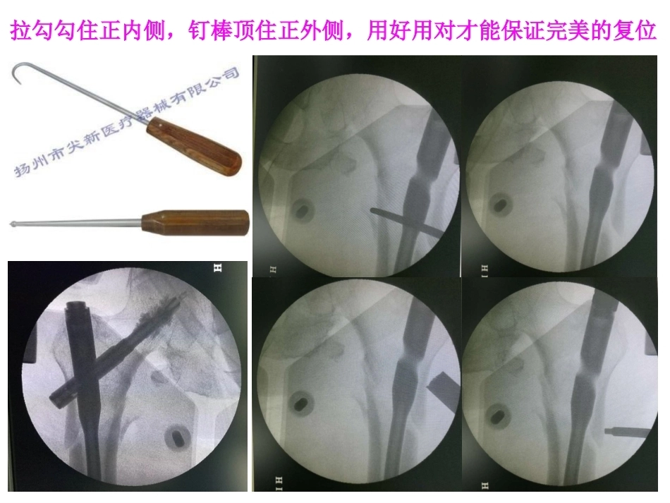 股骨近端骨折的几个感悟_第13页
