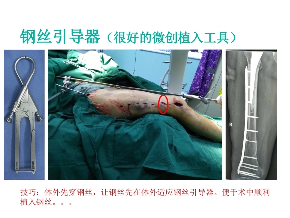 股骨近端骨折的几个感悟_第14页