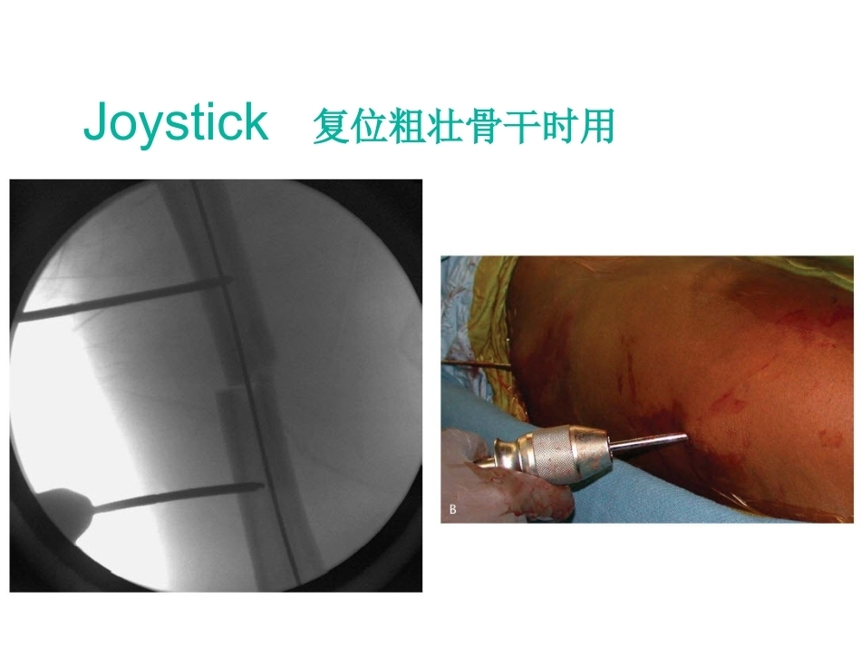 股骨近端骨折的几个感悟_第15页