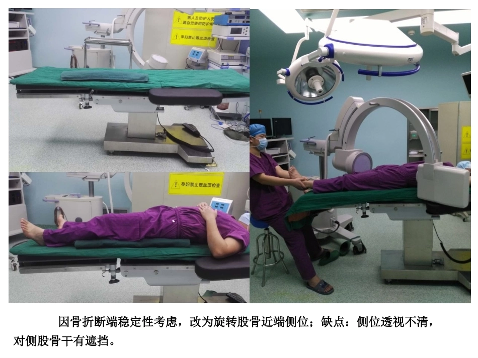 股骨近端骨折的几个感悟_第3页