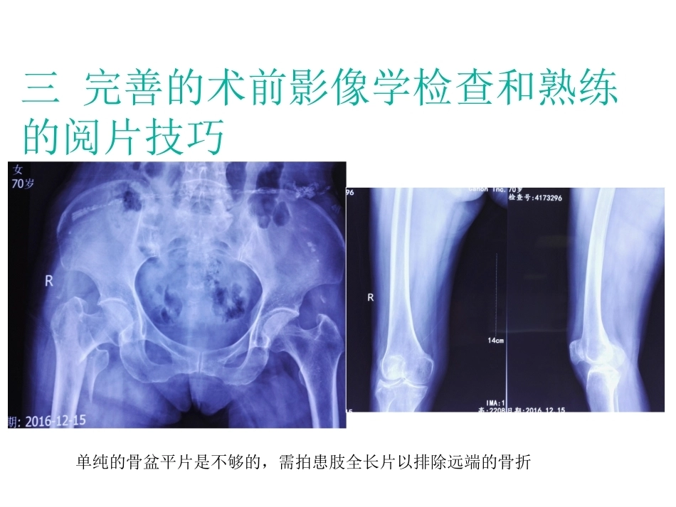 股骨近端骨折的几个感悟_第6页