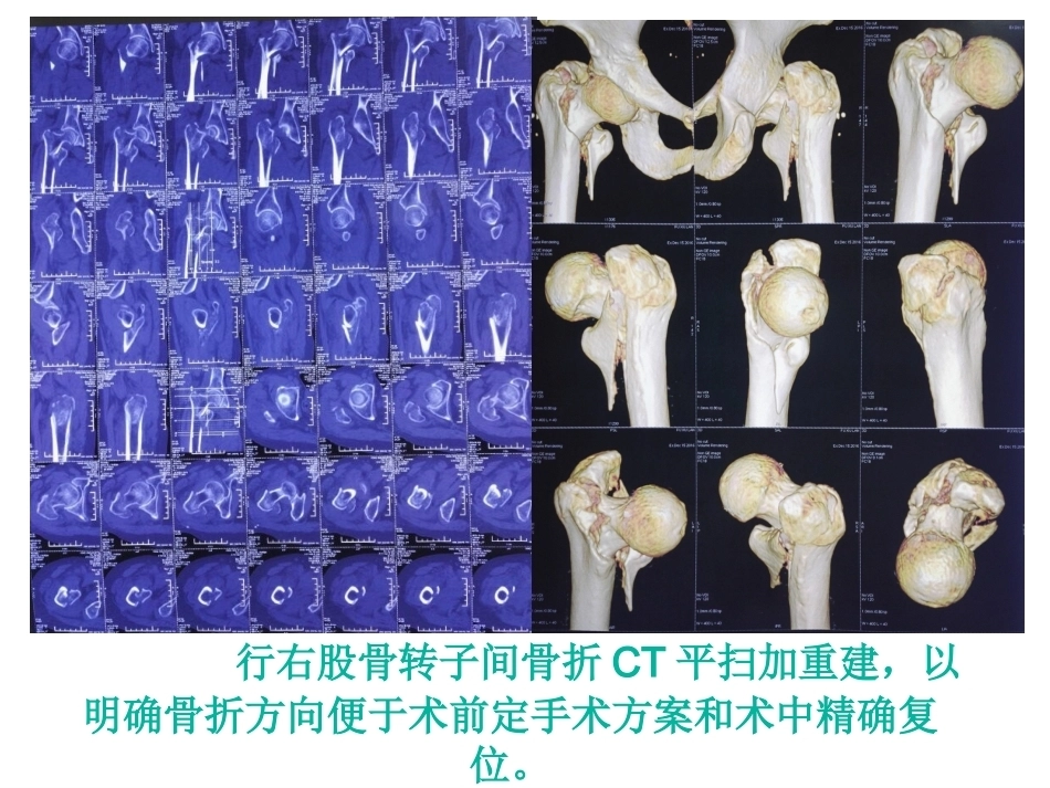 股骨近端骨折的几个感悟_第7页