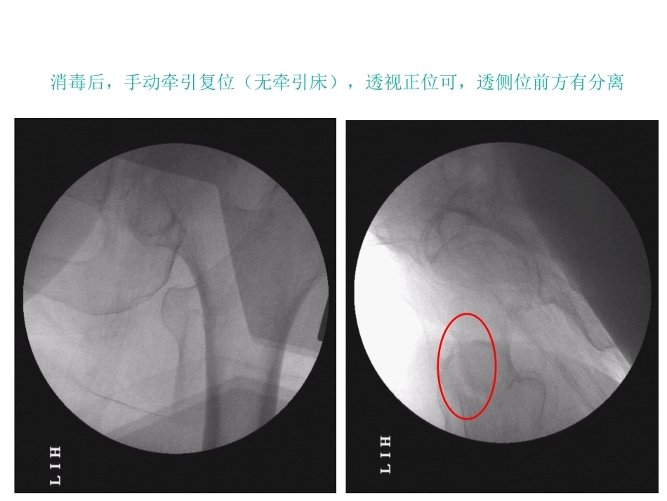 股骨近端骨折的几个感悟_第8页