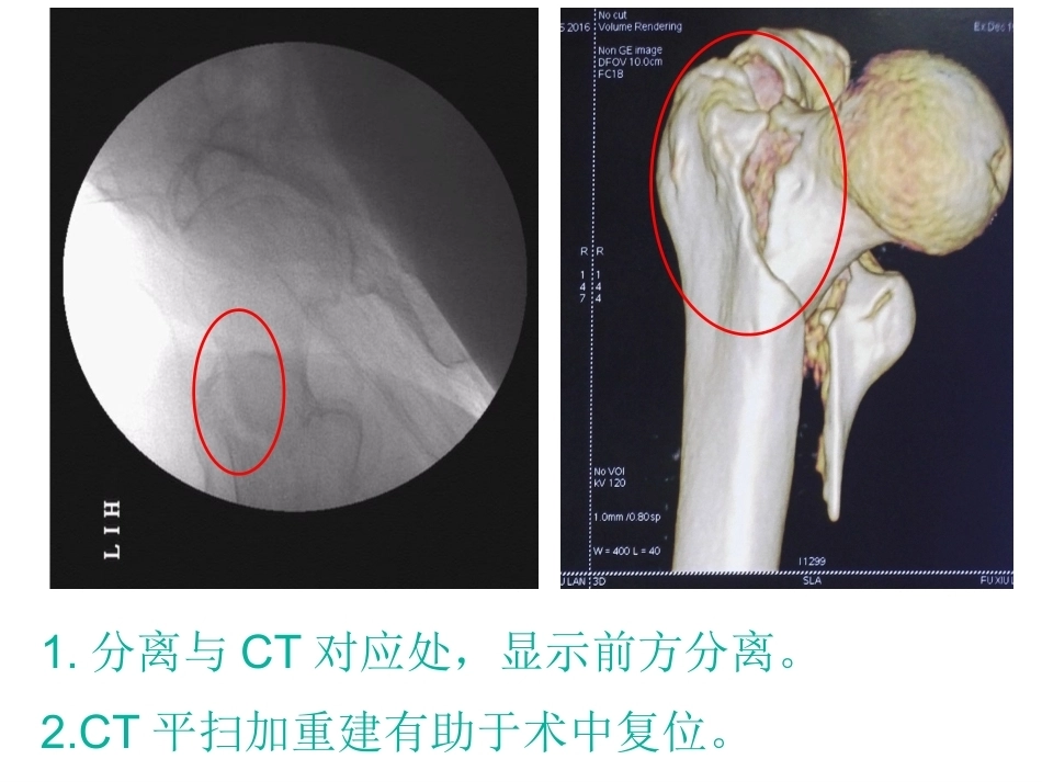股骨近端骨折的几个感悟_第9页