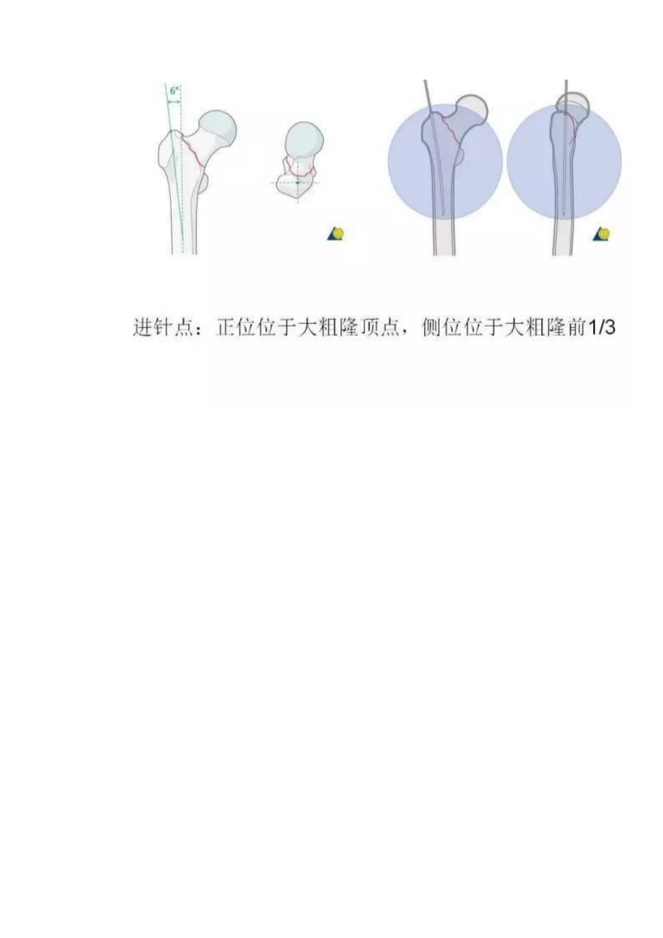 PFN 内固定治疗股骨粗隆间骨折_第10页
