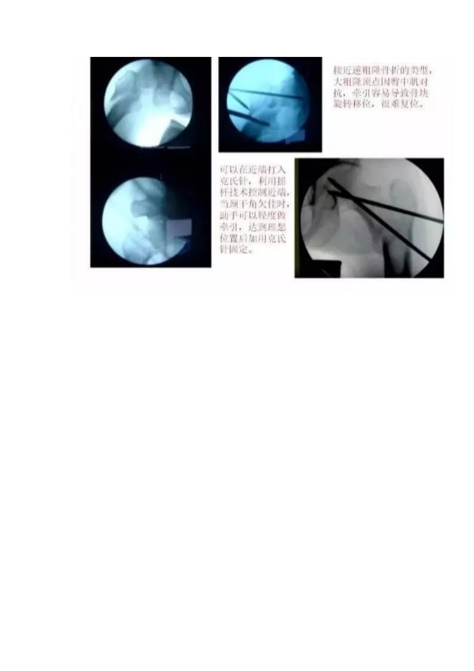 PFN 内固定治疗股骨粗隆间骨折_第13页