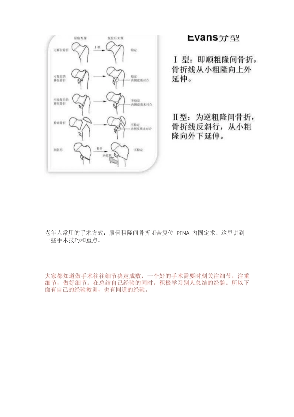 PFN 内固定治疗股骨粗隆间骨折_第2页