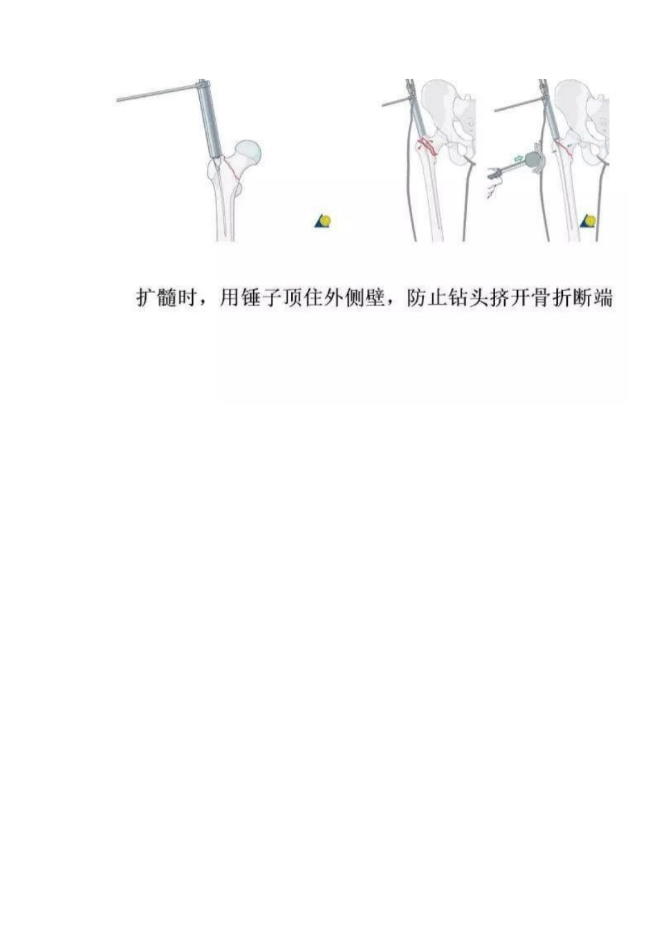 PFN 内固定治疗股骨粗隆间骨折_第9页