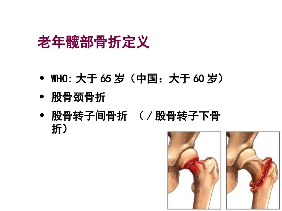 老年髋部骨折围手术期的评估与处理_第2页