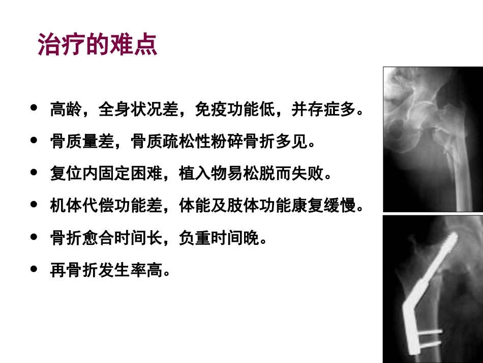 老年髋部骨折围手术期的评估与处理_第4页
