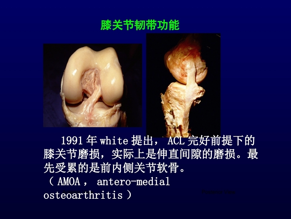单髁置换治疗膝关节OA的复件_第12页