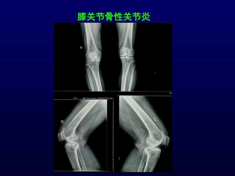 单髁置换治疗膝关节OA的复件_第8页