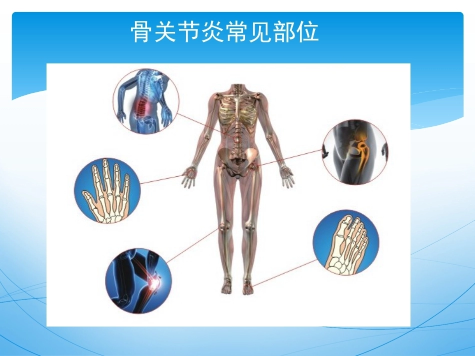 骨关节 炎的诊治_第10页