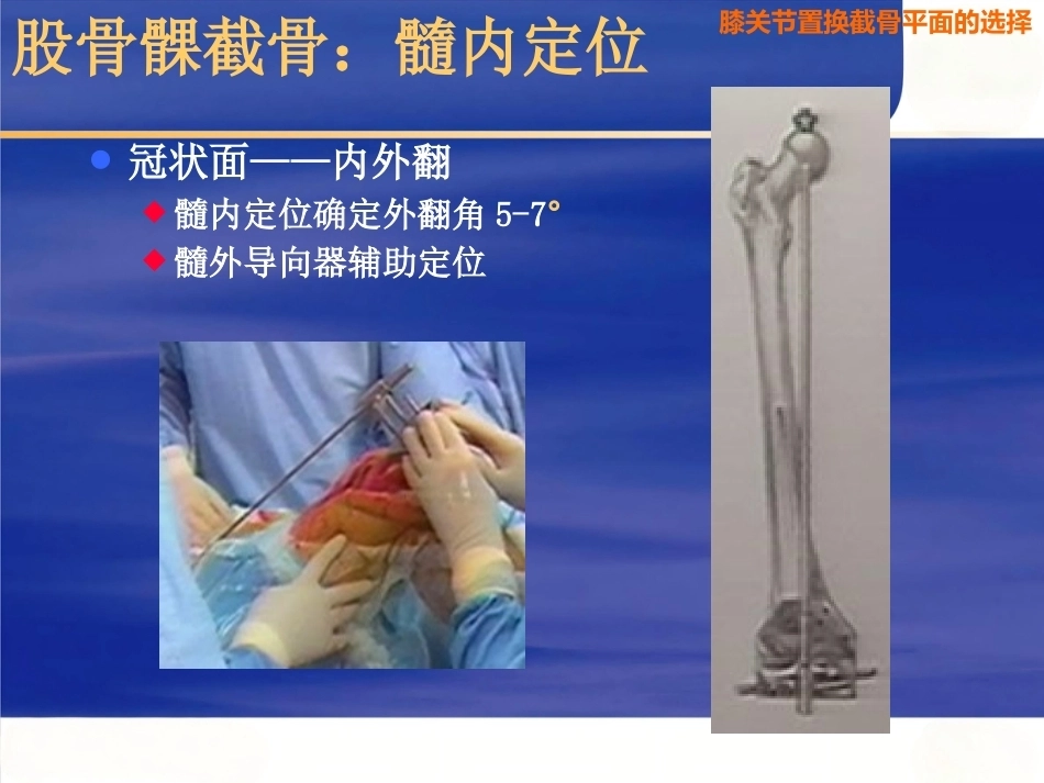 膝关节置换 截骨面的决定_第10页