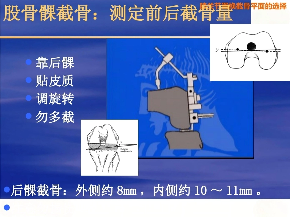 膝关节置换 截骨面的决定_第12页