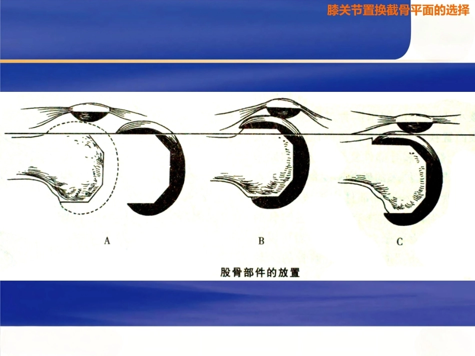 膝关节置换 截骨面的决定_第13页