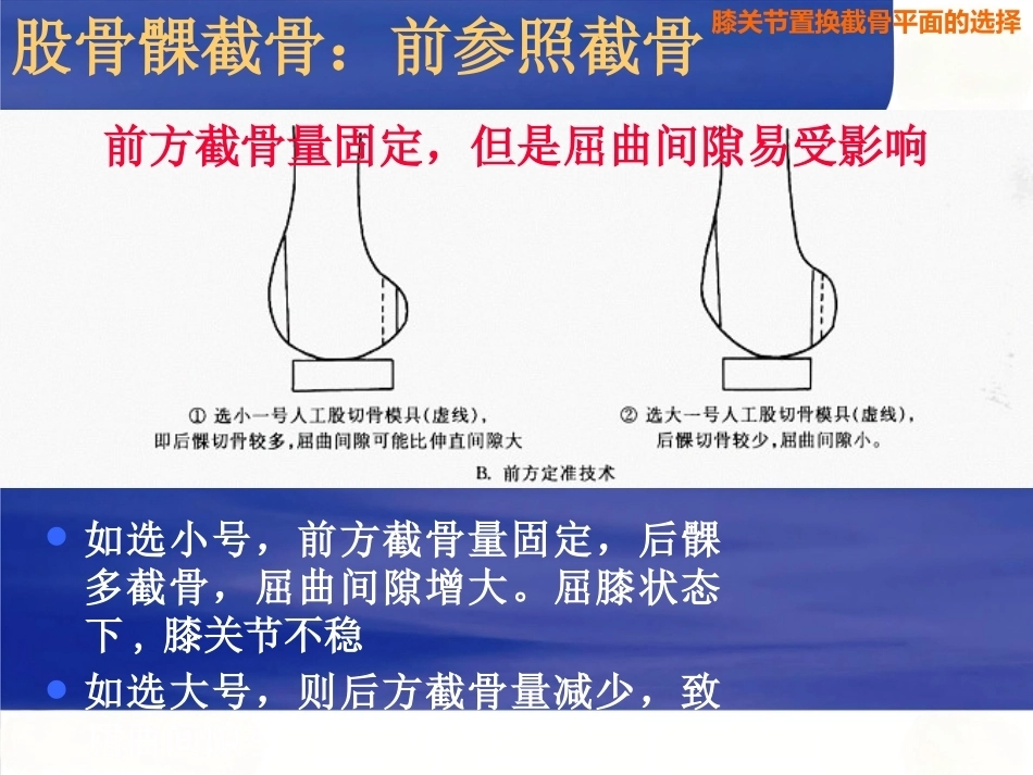 膝关节置换 截骨面的决定_第14页