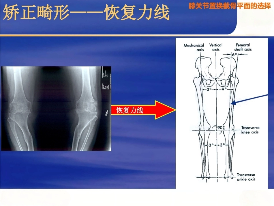 膝关节置换 截骨面的决定_第3页