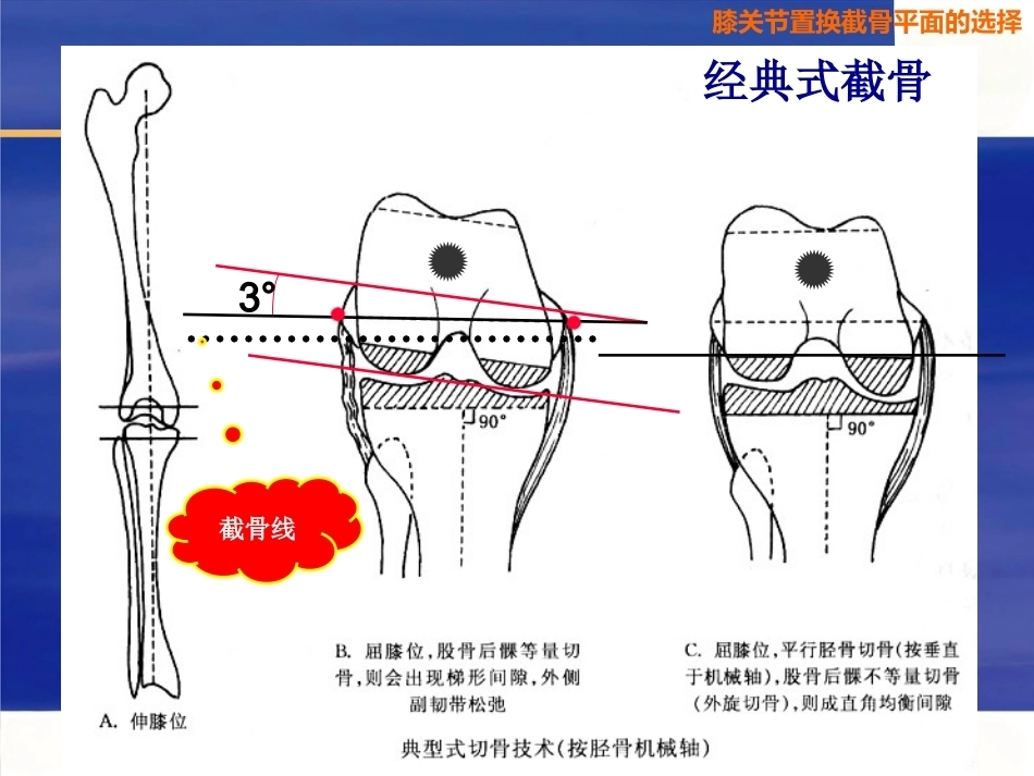 膝关节置换 截骨面的决定_第7页