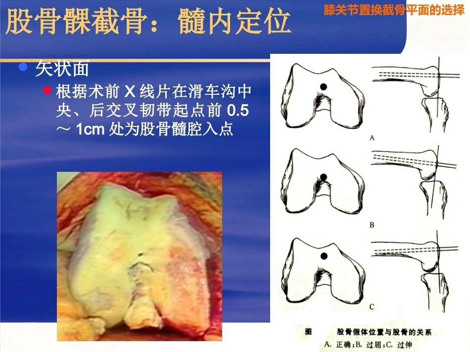 膝关节置换 截骨面的决定_第9页