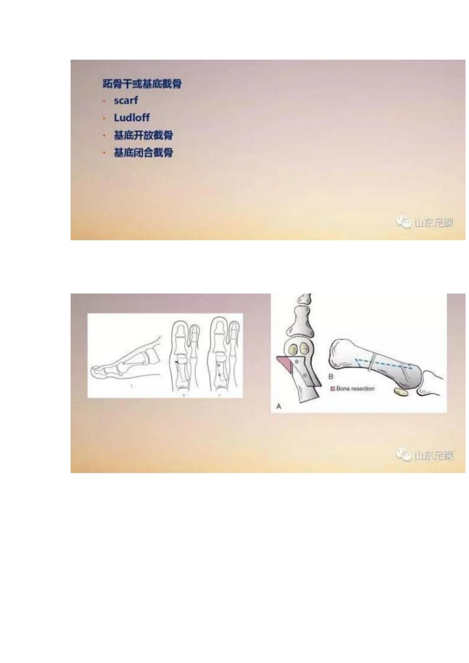 拇外翻的手 术治疗技巧_第11页