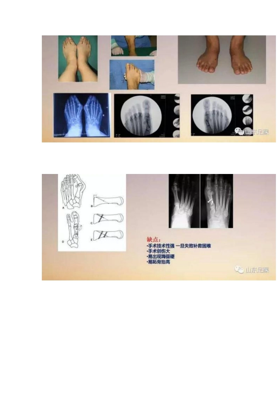 拇外翻的手 术治疗技巧_第13页