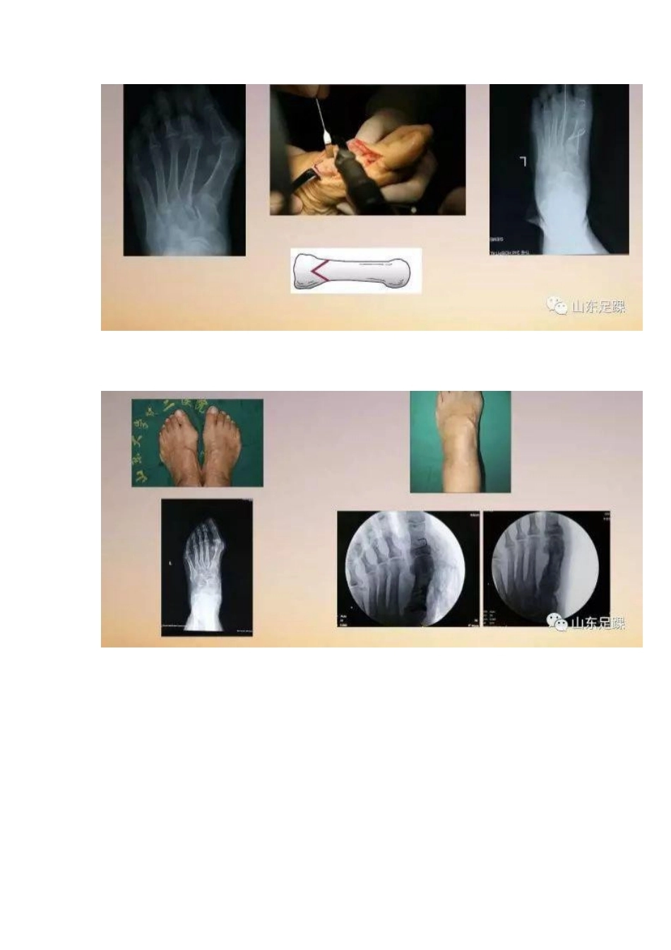 拇外翻的手 术治疗技巧_第14页