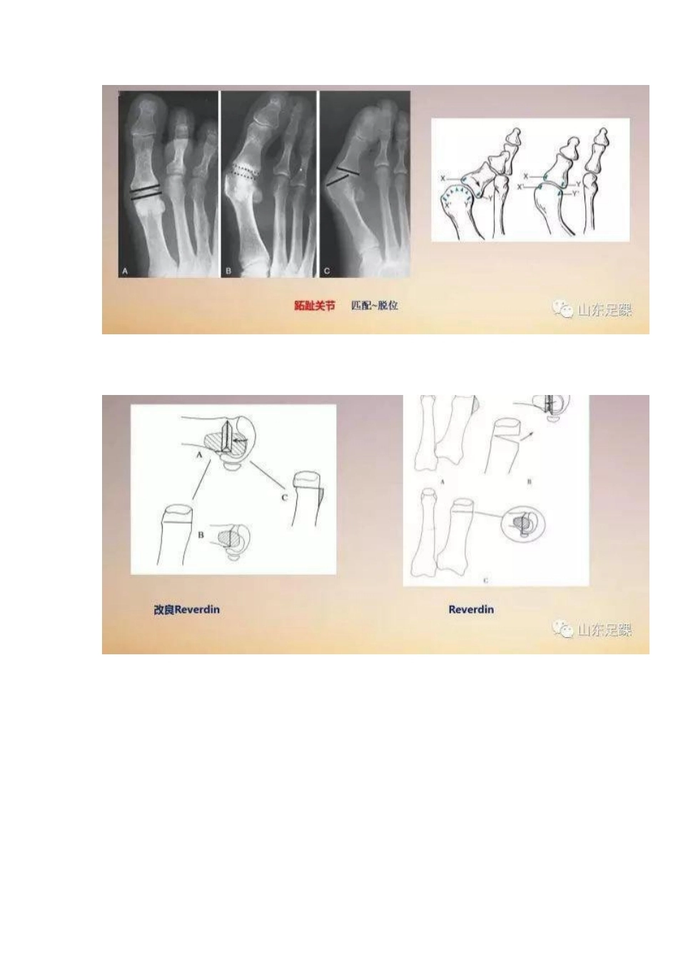 拇外翻的手 术治疗技巧_第15页
