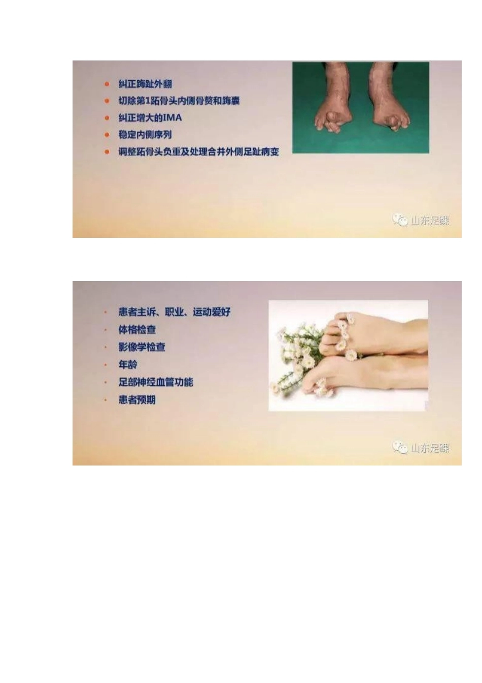 拇外翻的手 术治疗技巧_第3页
