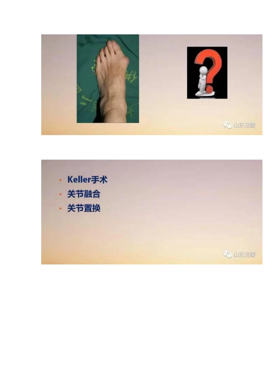 拇外翻的手 术治疗技巧_第4页