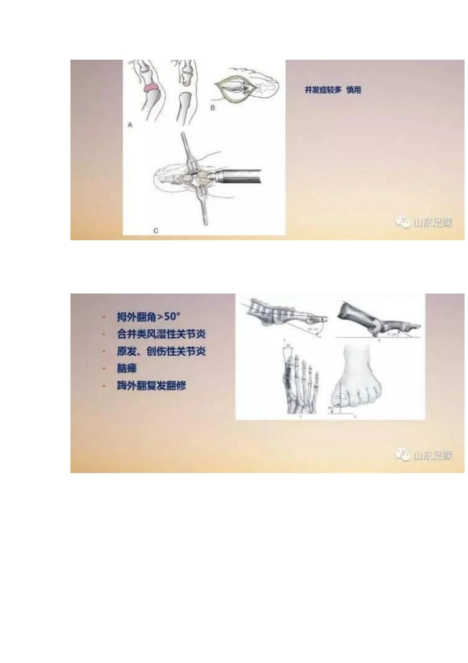 拇外翻的手 术治疗技巧_第5页